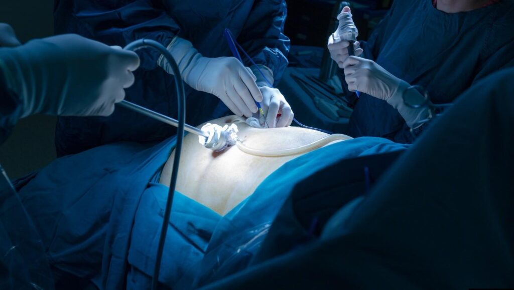 laproscopic Urology treatment