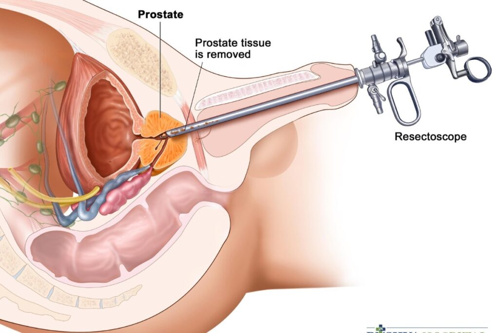 prostate laser treatment